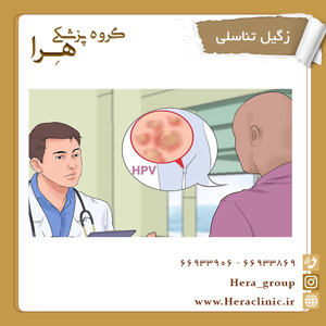 زگیل تناسلی