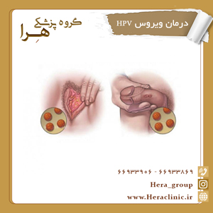 درمان ویروس HPV
