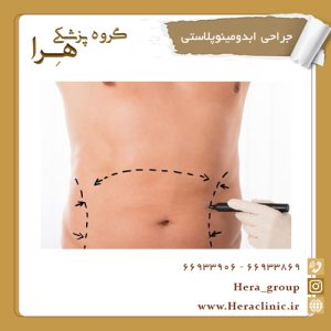 جراحی ابدومینوپلاستی